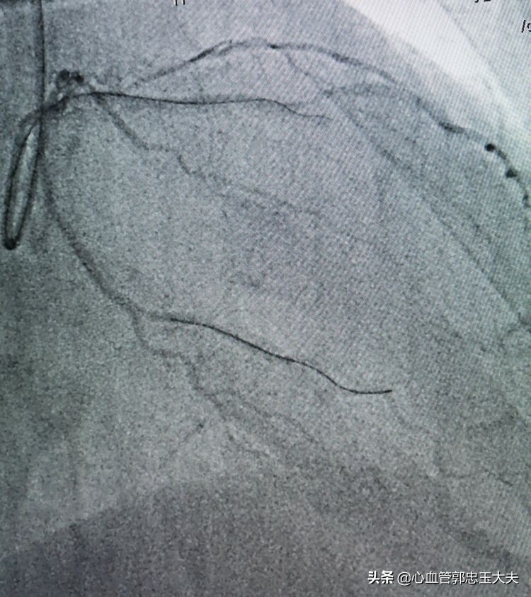 CTO遇到钙化病变怎样才能把血管打通？