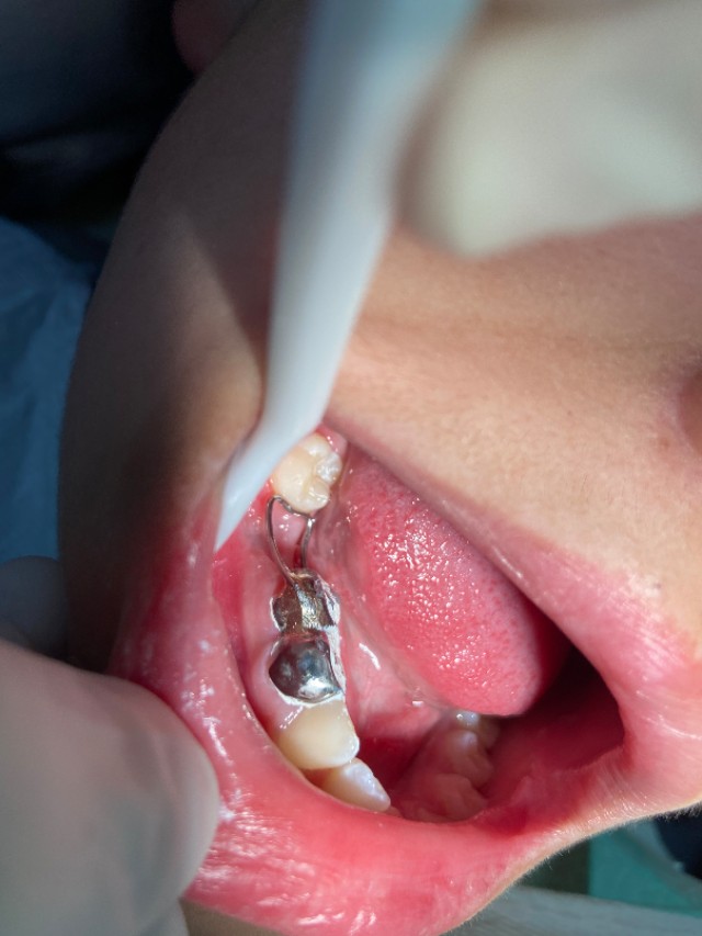 未成年人牙齿缺失怎么办,未成年人牙齿烂到不能补了怎么办