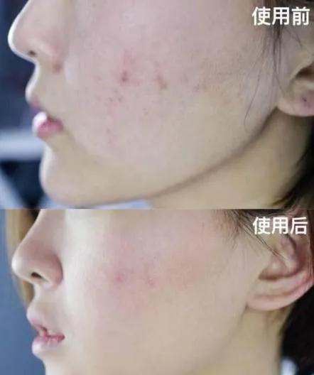 李佳琦推荐的提拉紧致美容仪,提拉紧致抗衰美容仪李佳琦