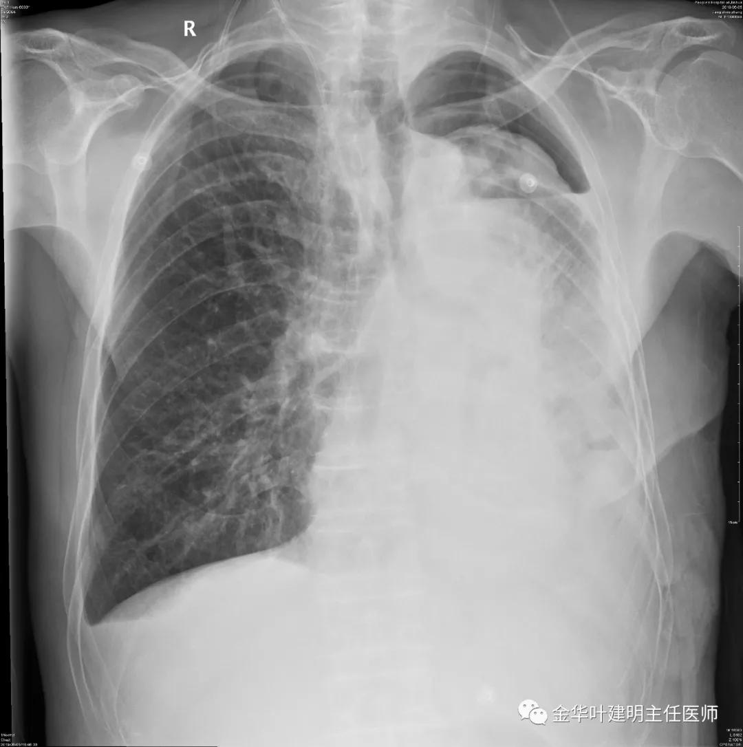 手术引起乳糜胸,有没有做了肺结节手术后是误诊的