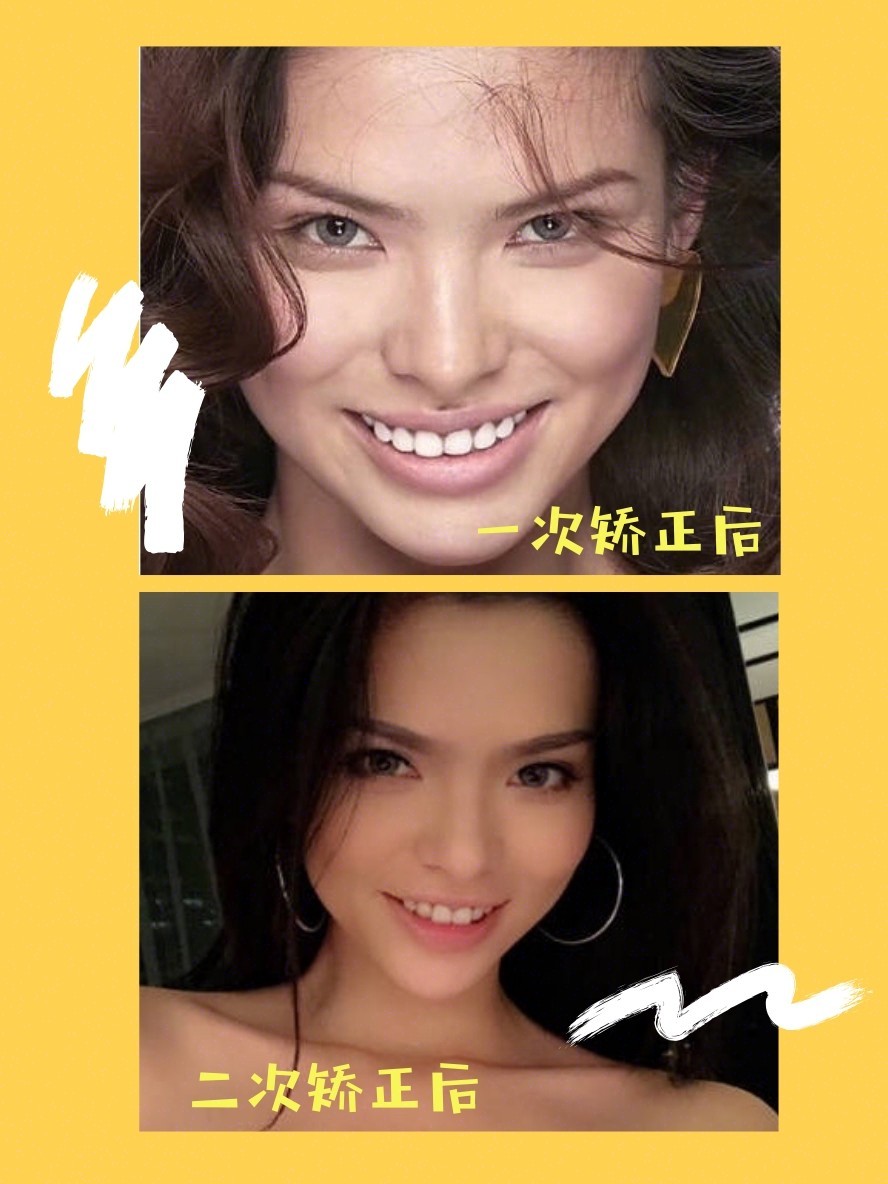 牙齿正畸必备品,正畸期间必备品