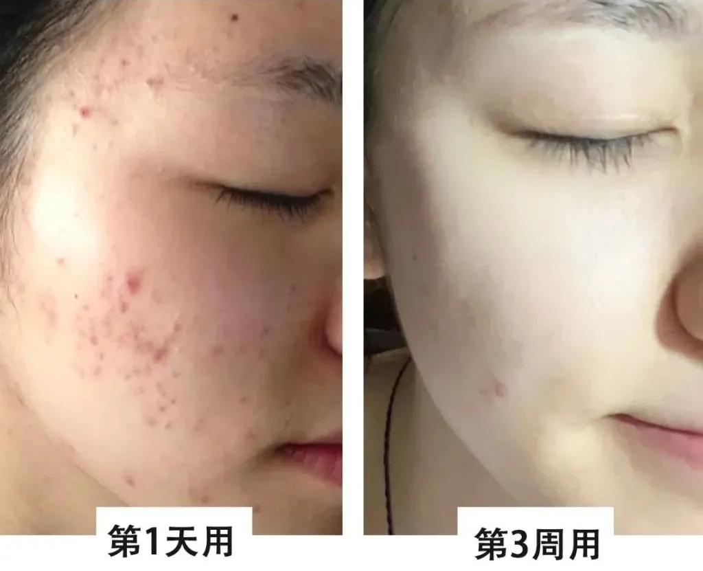 隐藏款改善黑头洗面奶,用完不长黑头和扩大毛孔的洗面奶