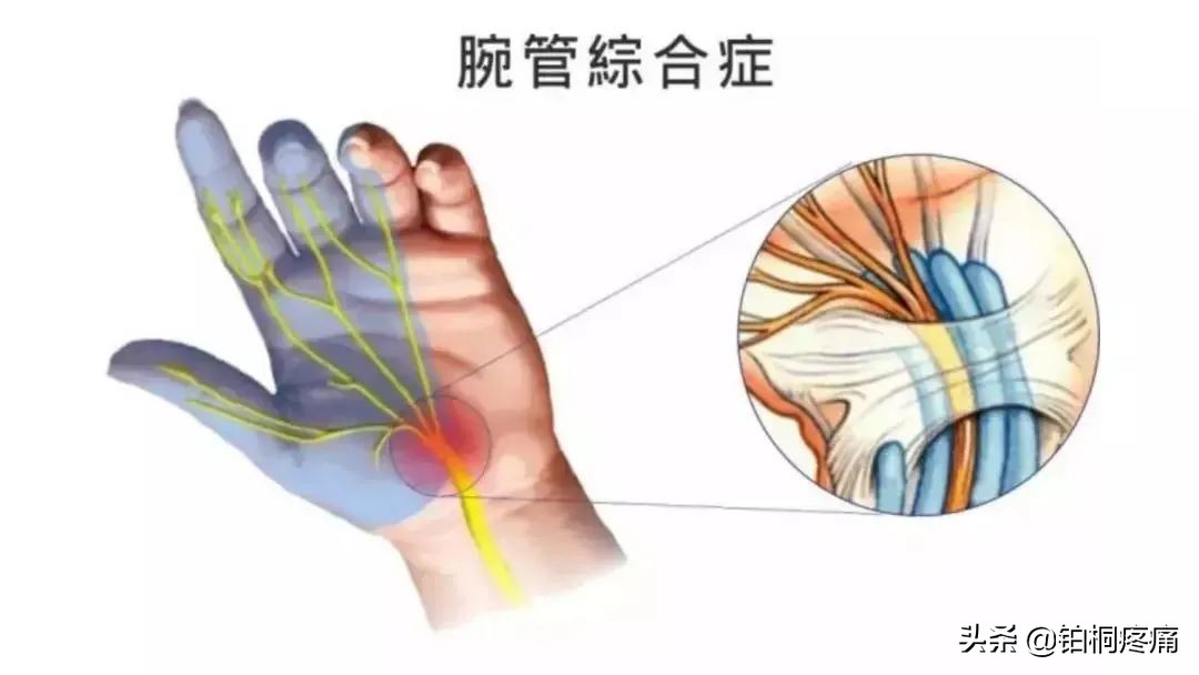 手麻、手痛、手无力？疼痛科一招帮您告别“鼠标手”