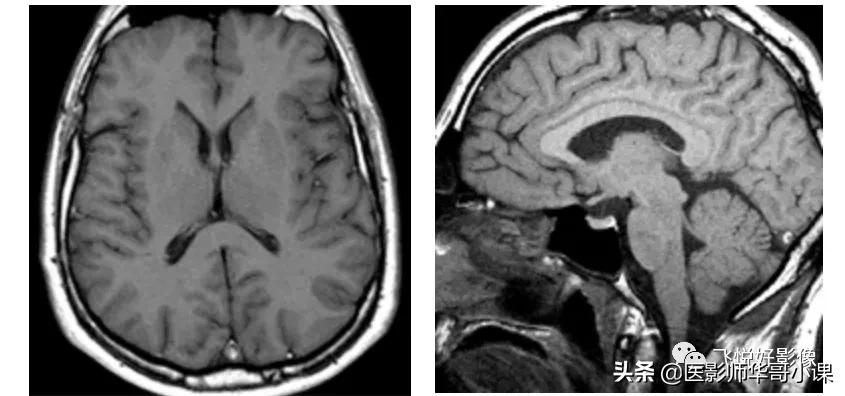 飞利浦磁共振序列参数解读,飞利浦磁共振波谱成像扫描技术