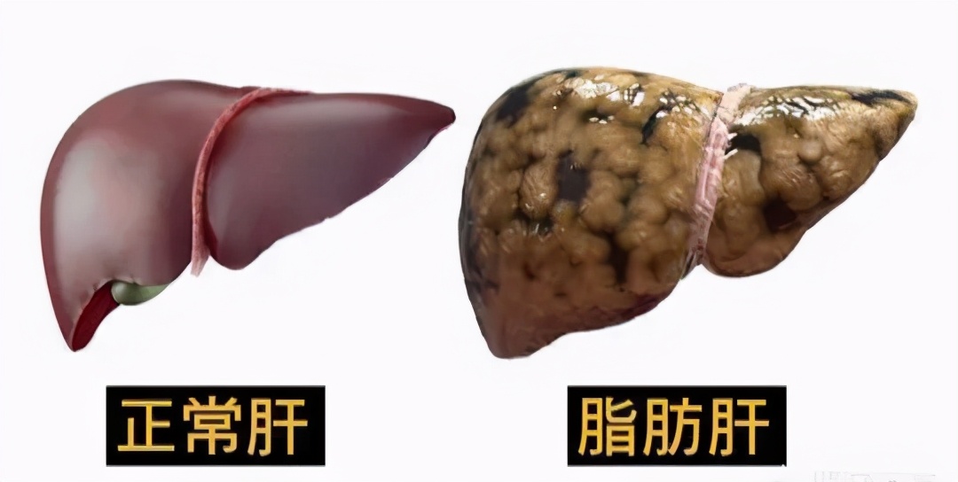 得了脂肪肝是不是就一定要戒烟,重度脂肪肝30天消除最快方法运动