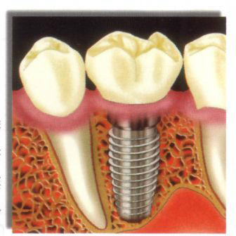 各种假牙价格一览表,假牙十大品牌价格表