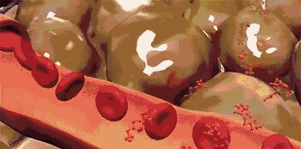 女子花8万做抽脂减肥,女子花68万做十次抽脂术