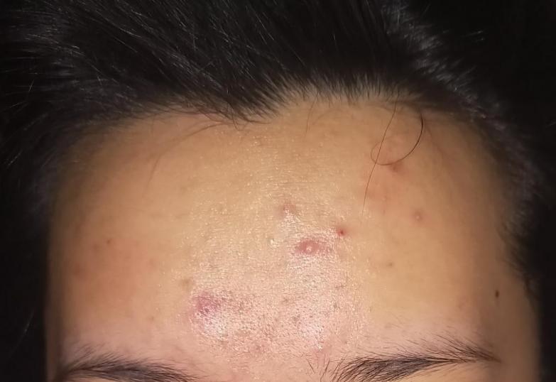 脸上长痘是身体原因还是皮肤原因,脸上长痘可能是什么病引起的