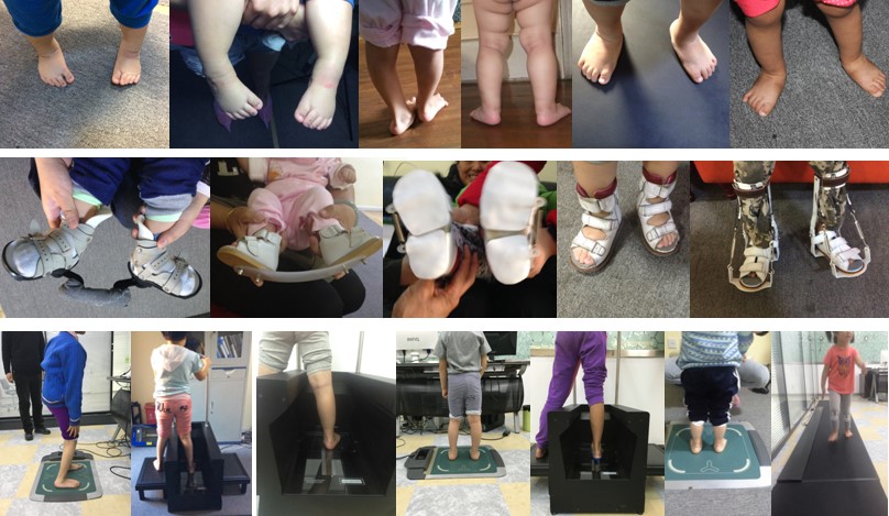 矫形鞋垫前后对比,矫形鞋和矫形鞋垫