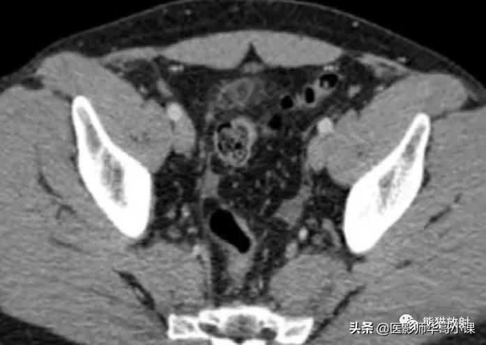 「精品课件」11种腹膜感染/炎症性病变的影像学表现