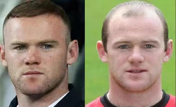 雄性激素旺盛的脱发植发有用吗,雄性脱发不植发吃药能好吗