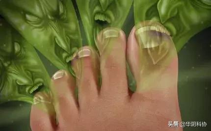 夏季脚气的最佳治疗方法,夏季脚气重是怎么回事