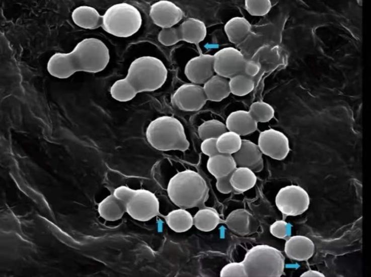 一到夏天腋窝下有汗斑是怎么回事,腋窝突然有一大块汗斑是怎么回事