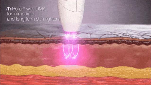 最新款射频美容仪,最好用的家用射频美容仪器