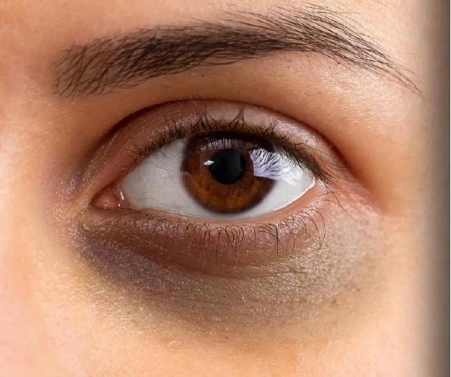 熬夜留下的黑眼圈怎么快速消除,熬夜看手机引起的黑眼圈可逆吗