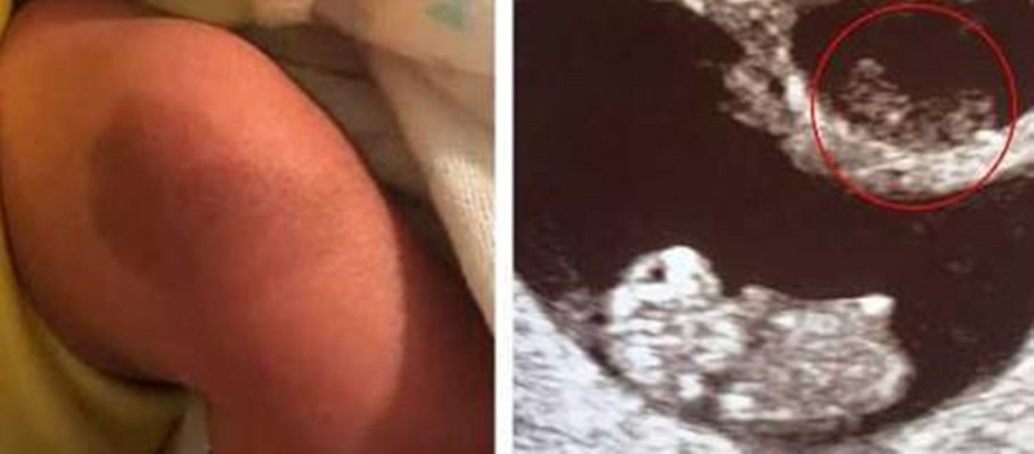 双胞胎妹妹身上有胎记,龙凤胎姐姐被抱养