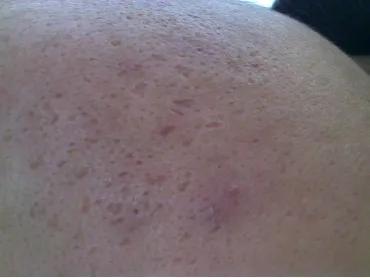 鼻子两侧毛孔粗大是什么原因,毛孔粗大原因及如何改善