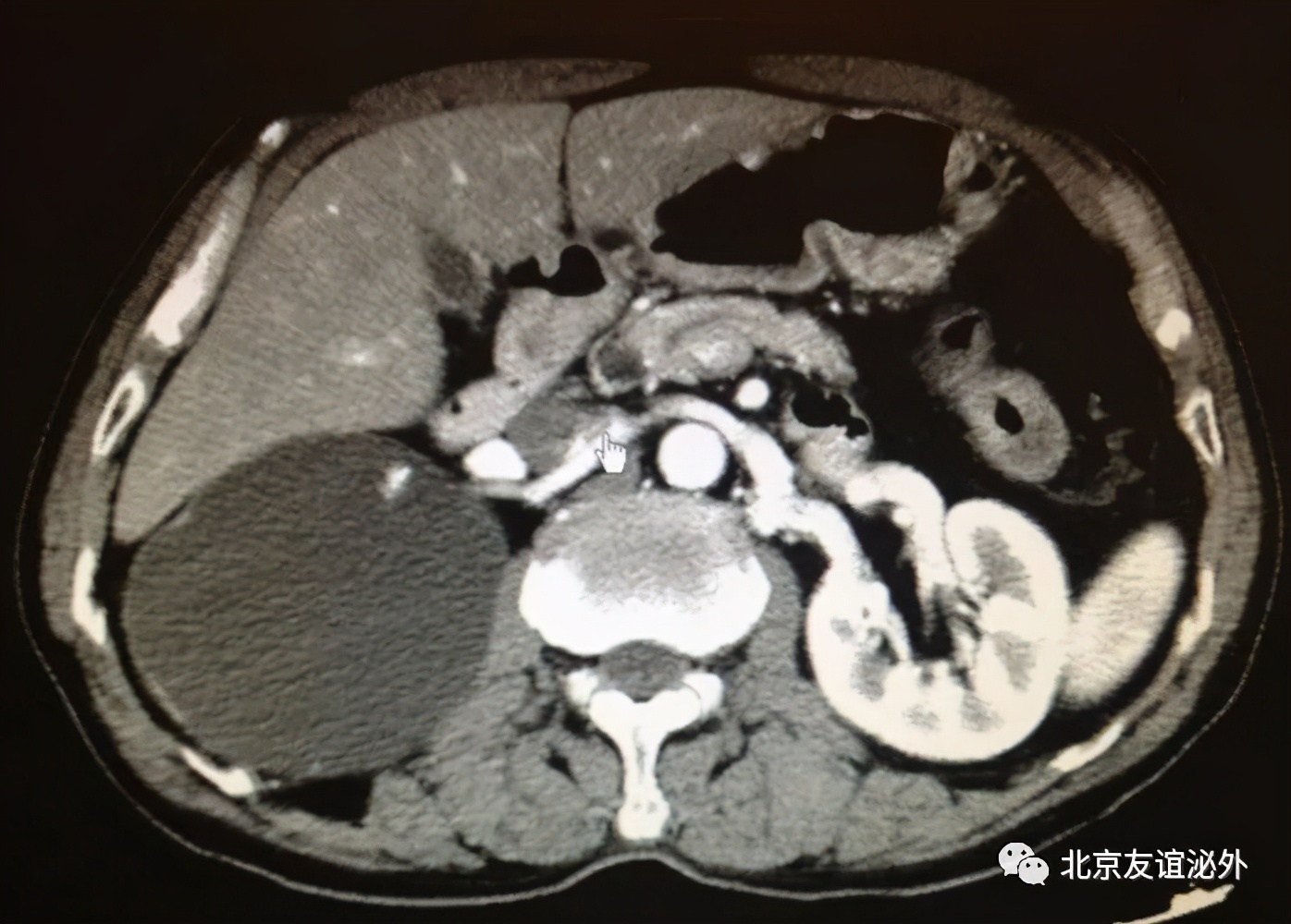 体检发现肾囊肿需不需要做手术,儿童体检发现肾囊肿