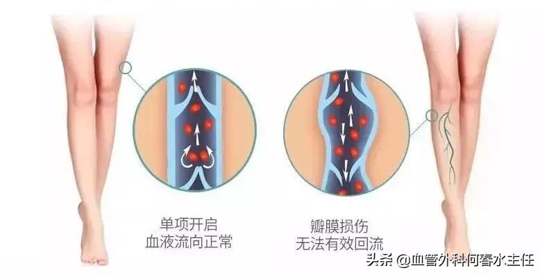 静脉曲张腿脚不好？治疗有“门路”