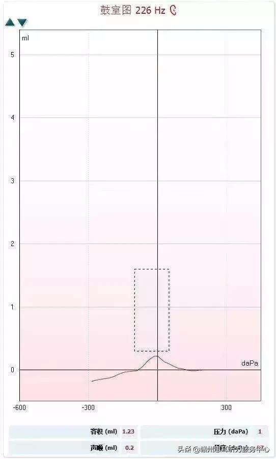 耳硬化症通过什么检查,耳硬化症的诊疗计划