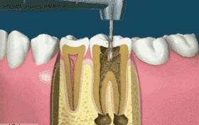 根管治疗后不做牙冠会怎样?