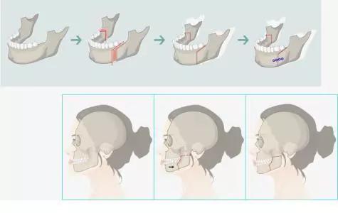 咱来侃侃“地包天”