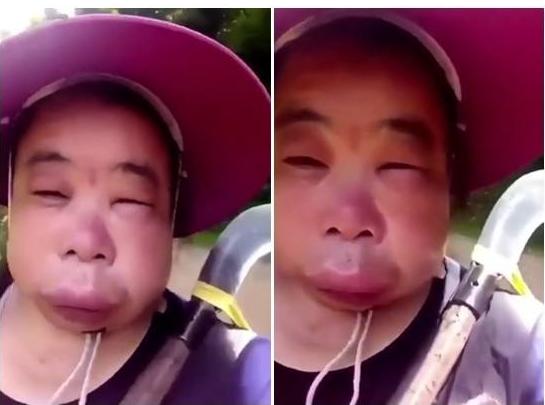 被蜜蜂蛰了100多针的女孩后续,小女孩被蜜蜂蛰了