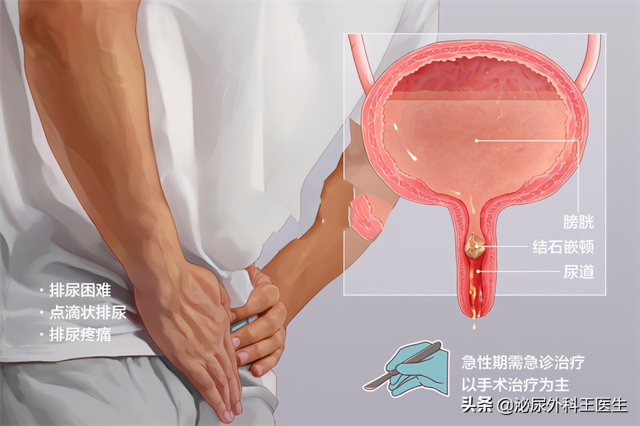 排石颗粒真的可以使结石变小吗,结石通和排石颗粒哪个效果更好