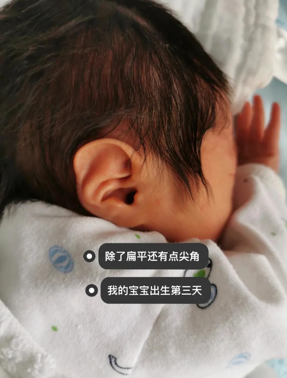 宝宝刚出生耳廓畸形，现在长成什么样了？