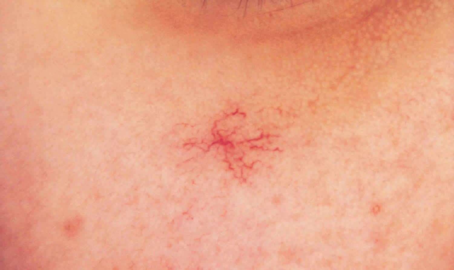 皮肤上有小黑点点是皮肤癌吗,癌症身上起小红点很痒图片