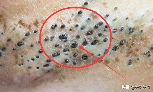 人为什么会长黑头求解：黑头白头的成因及结构和去除方法