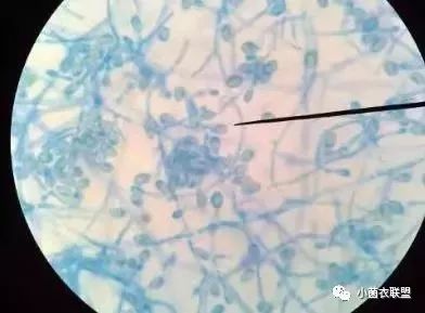 马油能治愈脚气吗,脚气可以治愈吗