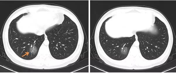 新型冠状病毒肺炎相关知识答疑,新型冠状病毒肺炎必须知道什么