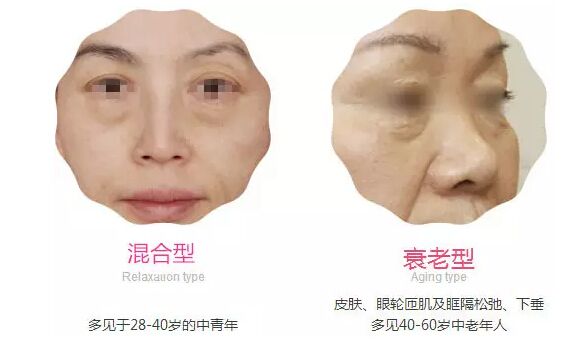 有眼袋是不是真的显老,有眼袋人显老快试试这个方法吧