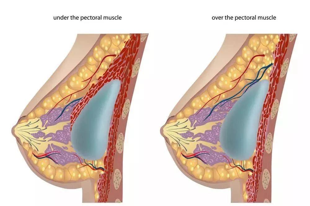 隆胸是现在胸围加上假体厚度吗,假体隆胸术后的胸围会缩一点吗