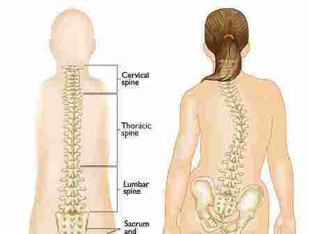 特发性青少年脊柱侧弯病因不明吗,青少年特发性脊柱侧弯怎么办