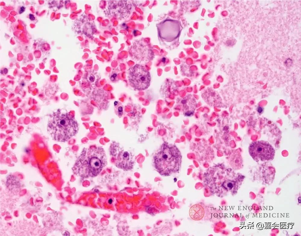 全身虚脱无力是什么原因,全身虚脱无力