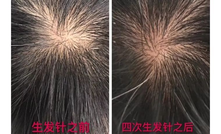 如何避免频繁戴口罩引起皮肤问题,戴口罩后护肤注意什么