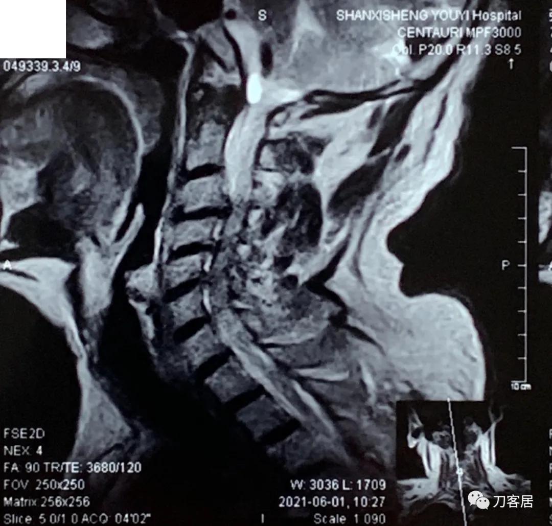70岁男性，神经根型颈椎病，片子显示较严重，我依然先行保守治疗