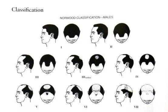 油腻脂溢性脱发,脂溢性脱发怎么抑制出油