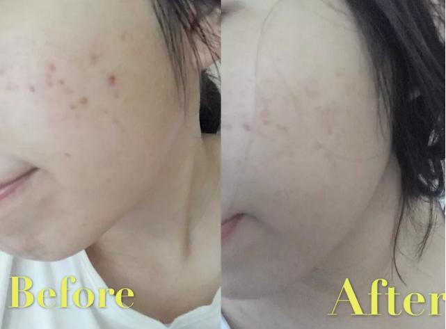 科普|光子嫩肤全攻略，做了光子后禁忌事项有哪些？