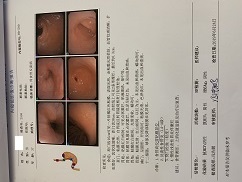 反流性食管炎引起的咽喉疼怎么办,反流性食管炎导致的喉咙疼怎么办