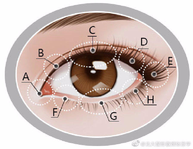 那些绝美的双眼皮手术,2022年最流行的双眼皮技术是哪个