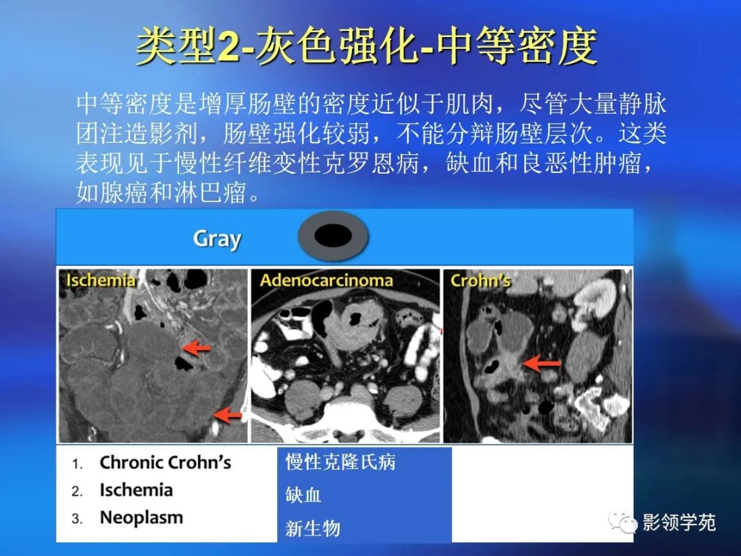 肠道内壁增厚,肠道扩张ct表现
