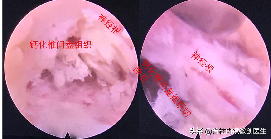 老年腰椎管狭窄的手术治疗,微创手术治疗腰椎管狭窄的技术