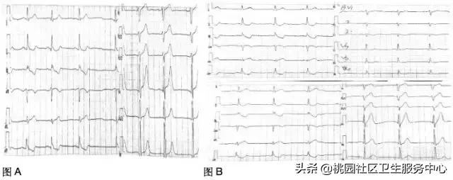 早期心梗心电图能查出来吗,警惕这种要命的心电图表现
