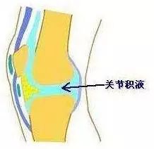骨科膝盖积液,骨科积水怎么办