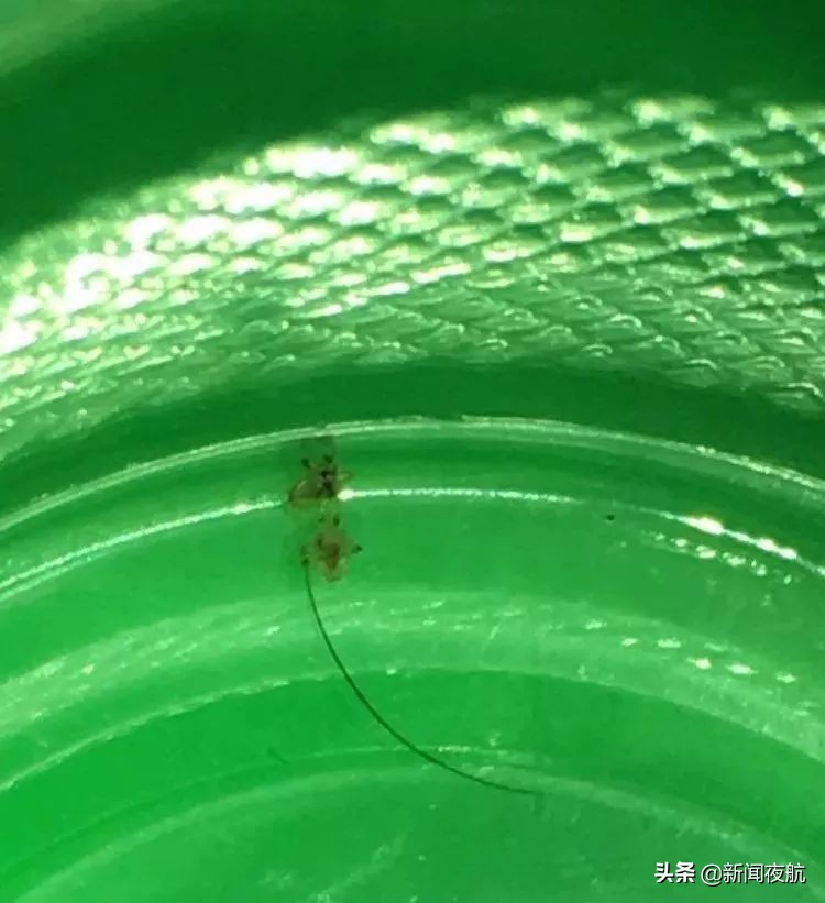 5岁女孩眼睛里取出20多只虱子,还在动!孩子总有这个动作,家长一定要重视