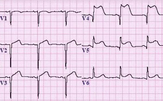 常见心梗特殊心电图,各部位心梗心电图详解