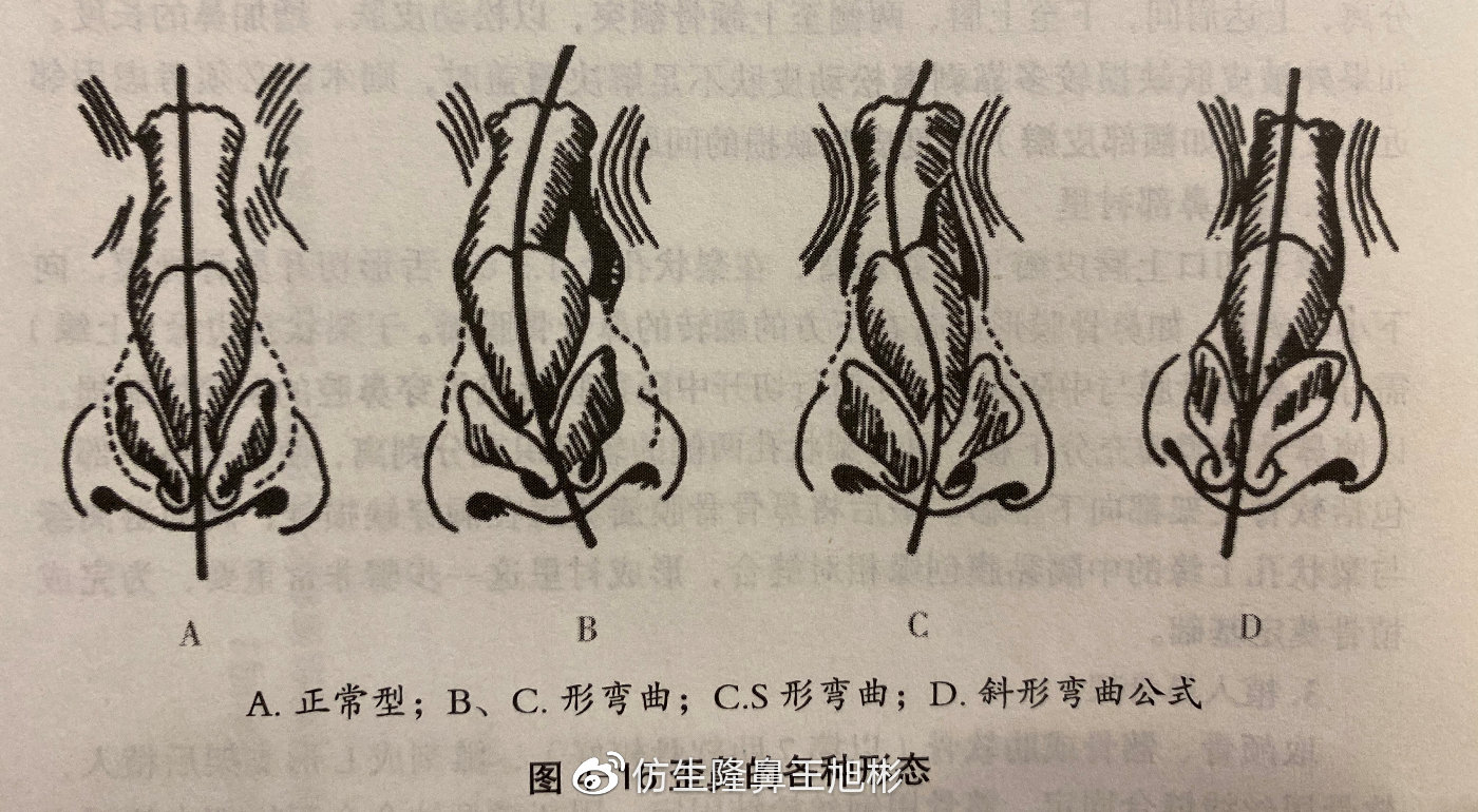天生鼻小柱歪斜有必要修复吗,天生鼻子歪做肋骨鼻可以矫正吗